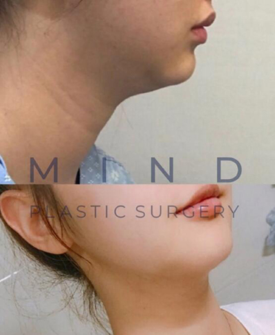 韩国MIND曼德整形外科面部吸脂前后对比照片
