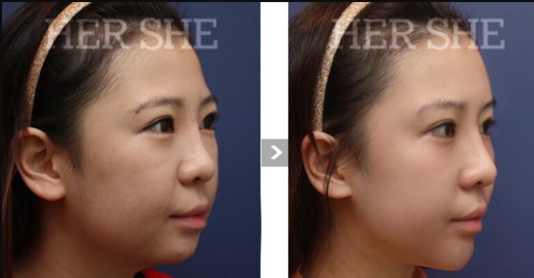 韩国赫尔希整形外科面部溶脂提升前后对比图