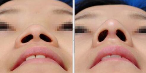 韩国赫尔希整形外科隆鼻前后对比照片