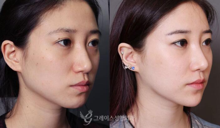 韩国格瑞丝整形外科轮廓整形前后照片