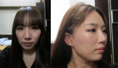 韩国普罗菲耳Profile轮廓整形术前图片