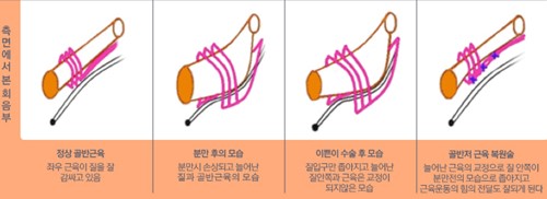 韩国Genien骨盆肌复原术示意图