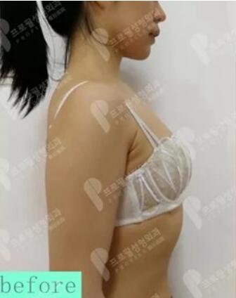 韩国普罗菲耳胸部整形术前照片