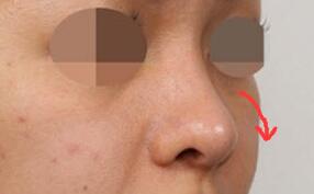 韩国薄皮肤隆鼻案例图