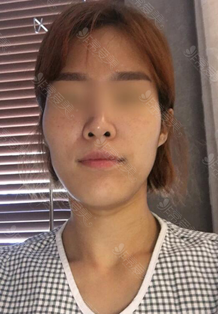 韩国菲斯莱茵轮廓手术术前照片
