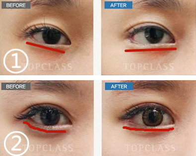 TOPCLASS外眼角手术前后对比图