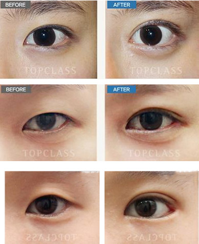 TOPCLASS外眼角手术前后对比图