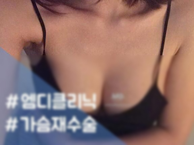 韩国MD整形外科胸部整形术后照片