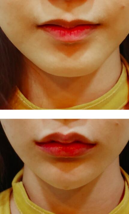 韩国娜飞整形外科唇部手术前后对比照