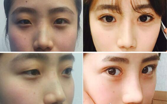 韩国娜飞整形外科眼鼻手术前后对比图
