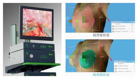 韩国医院用3DCT及内窥镜检查胸部
