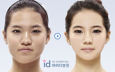 韩国ID面部不对称矫正案例图