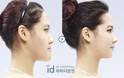 韩国ID面部不对称整形前后对比照片
