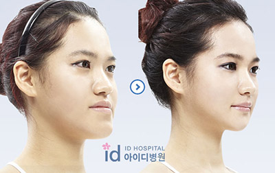 韩国ID面部不对称整形前后对比图
