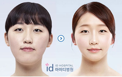 韩国ID医院地包天凸嘴矫正照片