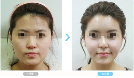 韩国一路美面部轮廓手术前后对比图