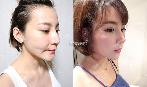 韩国GNG整形医院隆鼻手术好吗？无假体隆鼻是什么情况？