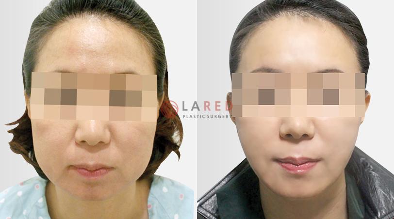韩国爱琳整形外科面部提升前后对比照片
