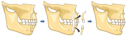 凸嘴手术截骨方法