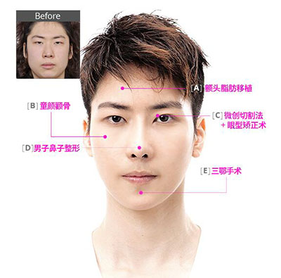 韩国ID整形外科地包天手术整形计划图