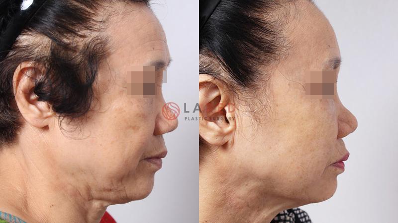 韩国爱琳整形外科面部提升手术前后对比照片