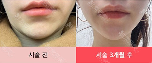 韩国raffine整形外科位置在哪？擅长皮肤护理和面部填充吗？