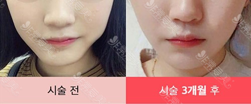 韩国raffine整形外科脸部溶脂图