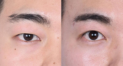 韩国JJ洪镇柱整形外科眼部整形前后对比照片