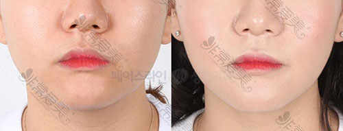 韩国菲斯莱茵瘦脸针注射前后对比照片