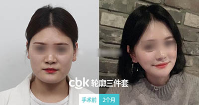 韩国CBK整形外科轮廓三件套案例图