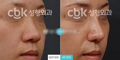 韩国CBK整形外科鼻部矫正案例图
