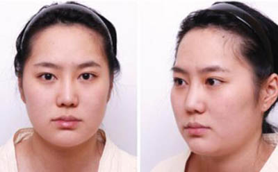 韩国世大特START整形外科面部整形术前照片