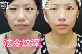 韩国鼻基底手术对法令纹有改善作用