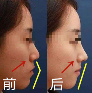 BIO整形医院鼻基底手术前后对比与图