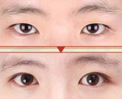 韩国BE&ME（妃美）整形外科眼部整形前后对比照片