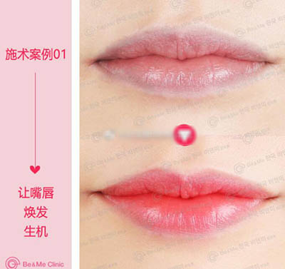 韩国BE&ME（妃美）整形外科唇部整形前后对比照片