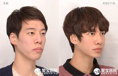 韩国爱宝整形医院男士双鄂手术前后对比照
