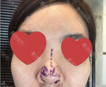 韩国Thenan整形鼻整形术前图