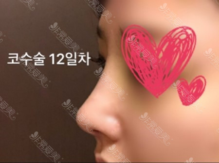 韩国Thenan鼻整形术后12天图