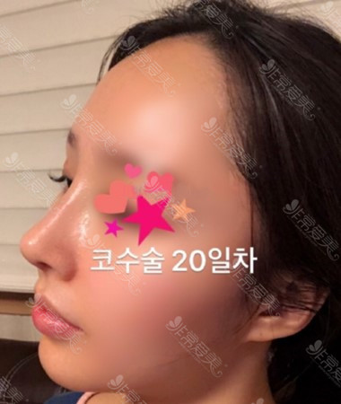 韩国Thenan鼻整形术后20天图