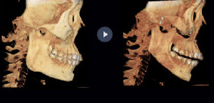 韩国viuu医院下颌角整形CT前后对比图
