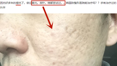 韩国陈整形医院用自体真皮术填痘坑,大量案例图告诉你效果!