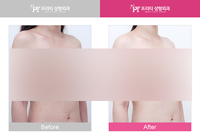 韩国PT整形外科胸部手术