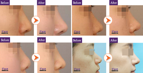 iFace整形外科隆鼻案例对比