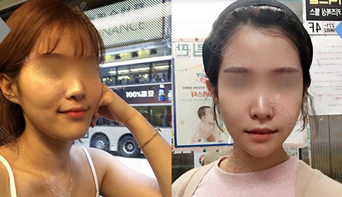 韩国菲斯莱茵轮廓手术前后对比照片