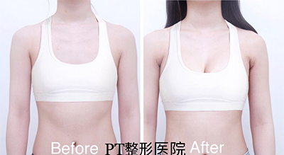 韩国PT整形外科隆胸案例