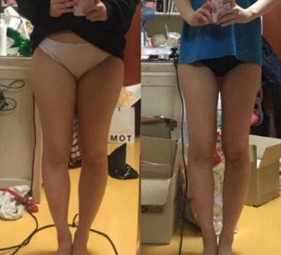韩国美线吸脂医院瘦大小腿案例图