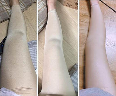 韩国美线整形外科腿部吸脂案例图