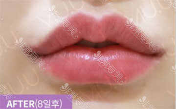 韩国VIUU整形口唇整形案例图