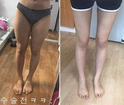 韩国美线整形吸脂瘦大腿前后恢复照片案例